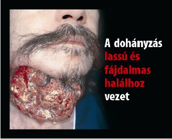 Hungary 2012 Health Effects death - diseased organ, gross